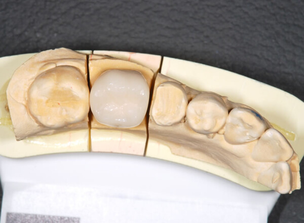 CADCAM冠大臼歯